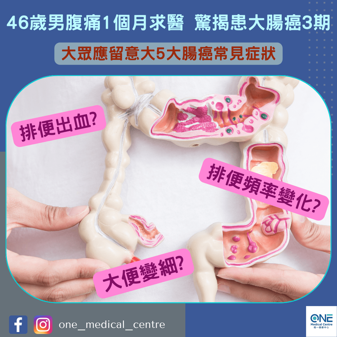 【46歲男腹痛1個月求醫 驚揭患大腸癌3期😷】