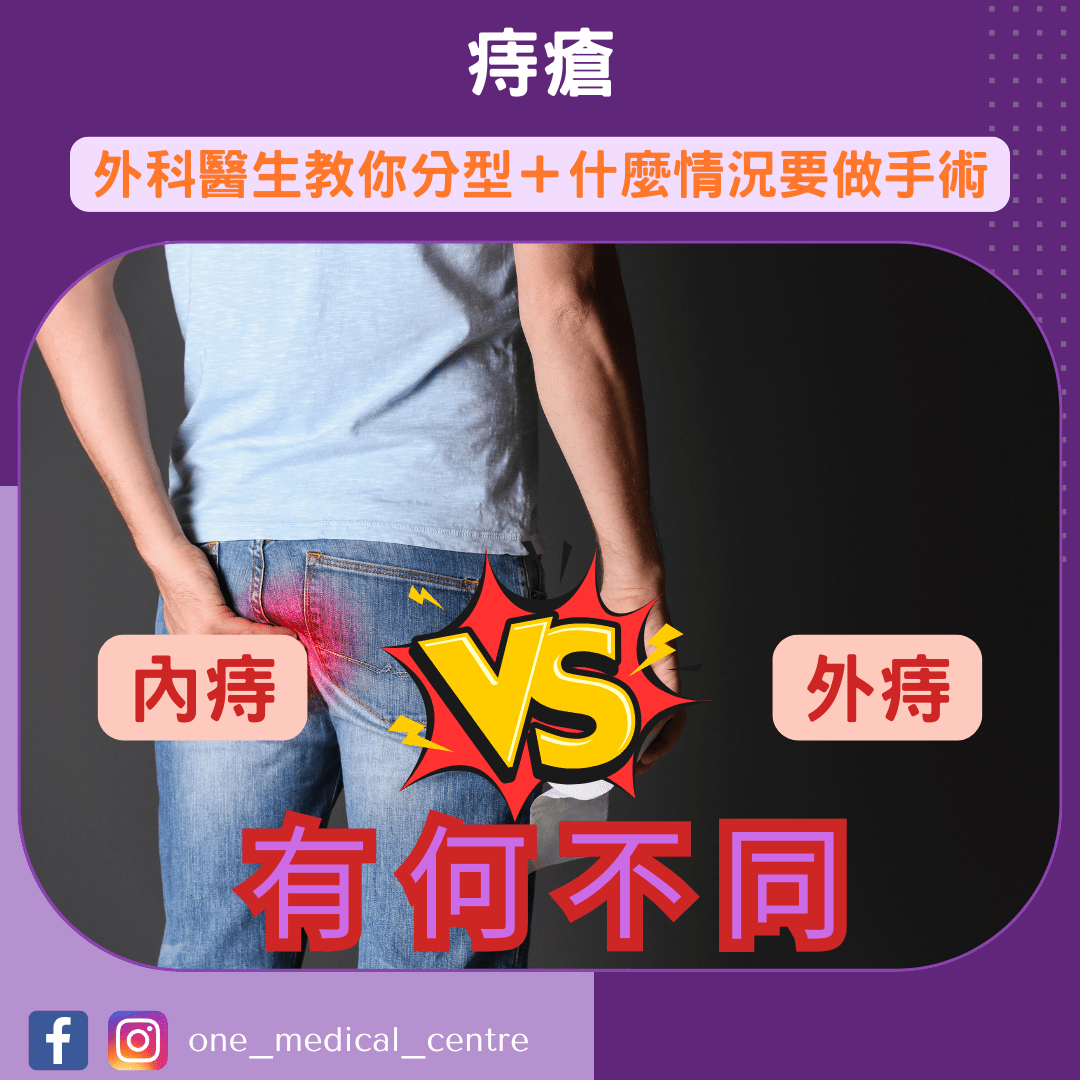 【久坐馬桶超易生痔瘡💺 外科醫生教你分型＋3 大情況要做手術】